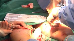 Kỹ thuật mới chữa bệnh giãn tĩnh mạch chân không cần mổ