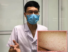 Chuyên gia chỉ rõ những dấu hiệu trên da của bệnh nhân COVID-19