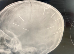 Kẻ găm đinh vào đầu bé gái 3 tuổi quanh co chối tội