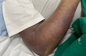 Sốt xuất huyết ở Hà Nội hạ nhiệt