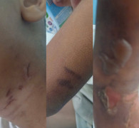 'Dì ghẻ' khai đổ nước sôi lên người để dạy dỗ bé trai 6 tuổi ở TP.HCM