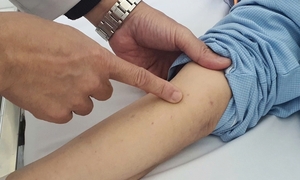 Bệnh não mô cầu gia tăng, bác sĩ cảnh báo triệu chứng dễ nhầm với cảm cúm