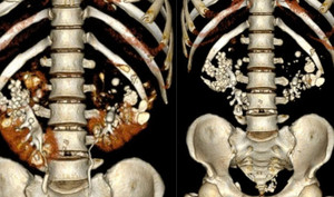 6 thói quen vào buổi sáng giúp bảo vệ thận