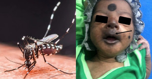 Bệnh 'người đi khom lưng' gia tăng tại châu Á, nguy cơ xâm nhập vào Việt Nam