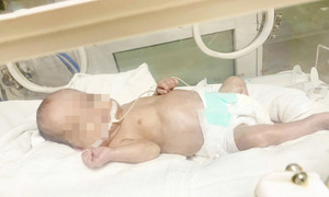 120 ngày giành giật sự sống cho bé sinh non 500gr phải thở máy kéo dài