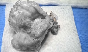 'U gạc' nằm im âm thầm 4 năm sau nâng ngực