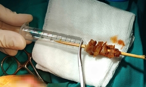Cuộc hội chẩn xuyên đêm cứu bé gái gặp tai nạn hi hữu do que xiên thịt