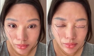 Phẫu thuật mí mắt hỏng, nạn nhân còn bị kiện ngược