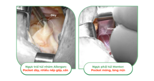 Khác nhau giữa túi ngực nhám và túi ngực trơn trên cùng 1 cơ thể