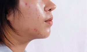 Sai lầm khi chăm sóc da dầu khiến mặt bóng như chảo mỡ