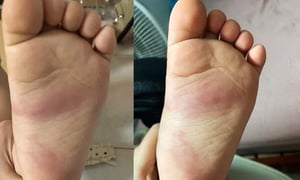 Hưng Yên: Xác minh phản ánh trẻ 3 tuổi bị bầm tím chân sau khi ở trường mầm non về