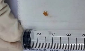 Tưởng viêm phế quản, bé 3 tuổi mắc dị vật đường thở suốt hơn 1 tháng