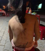 Bé gái 6 tuổi ở Quảng Nam bị bà cố nội đánh thâm tím mình mẩy