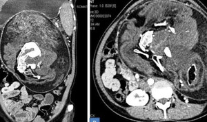 Cô gái mang song thai suốt 17 năm không hề hay biết