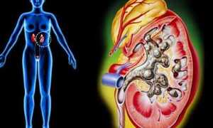 Dấu hiệu bất ngờ cảnh báo viêm cầu thận cấp