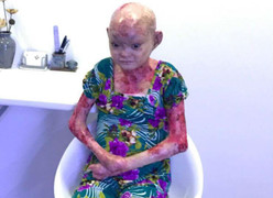 Mắc bệnh lở loét khắp cơ thể, thiếu nữ mang hình hài quái nhân