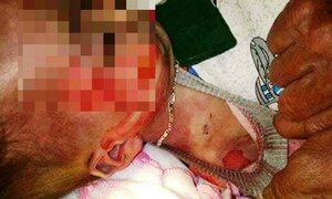 Bé 15 tháng chết với vết thương lạ: Khai quật tử thi điều tra nghi án bị bác sĩ đánh rơi