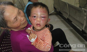 Bé trai 2 tuổi mặt sưng vù thâm tím, nghi bị bạo hành