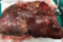 Cắt thành công khối u lách nặng gần 3kg ở Cần Thơ