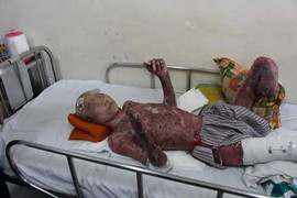 102 ngày giành giật sự sống cho bệnh nhân bỏng toàn thân vì hút thuốc gần bình xăng