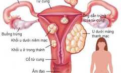 U xơ tử cung: Căn bệnh nguy hiểm phụ nữ dễ mắc phải mà không biết