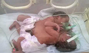 Bệnh quá nguy kịch, gia đình xin đưa cặp sơ sinh dính liền bụng, ngực về quê