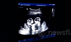 Thai nhi song sinh 'đánh nhau' trong bụng mẹ