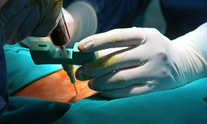 Ứng dụng thành công kỹ thuật ghép tế bào gốc giá rẻ