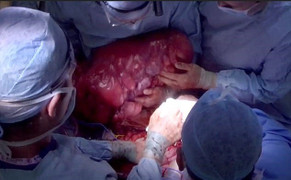 Cụ bà 74 tuổi mang khối u 19kg nhiều năm trong bụng