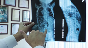 Bé trai 11 tháng tuổi nuốt 16 chiếc kim khâu trong bụng