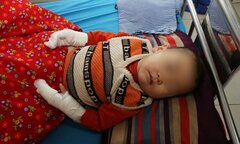 Cẩn thận bỏng nước sôi ở trẻ nhỏ trong mùa đông