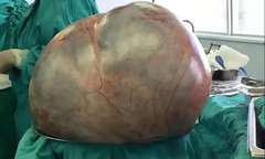 Người phụ nữ mang khối u nặng tới 34 kg trong bụng
