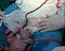 Cấp cứu thành công trường hợp suy thai do tắc động mạch rốn hiếm gặp