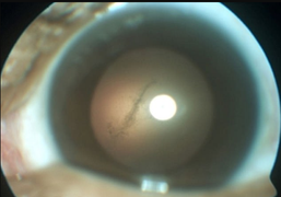 Suýt mù mắt, nhận quả đắng nhớ đời vì ăn thịt lợn chưa nấu chín