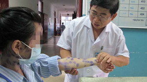 Vì sao bệnh thủy đậu lành tính nhưng có thể biến chứng chết người?