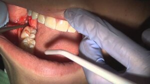 Nhổ răng số 8 có thể gặp những biến chứng nguy hiểm gì?