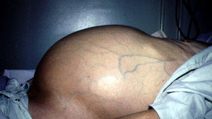 Những dấu hiệu cảnh báo ung thư gan, bạn cần chú ý