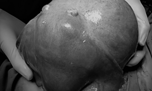 Không nên chủ quan với u xơ cổ tử cung vì lý do này