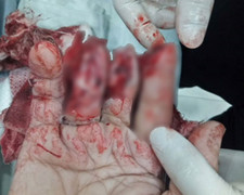 Đứt lìa ngón tay, không thể khâu nối vì sai lầm này