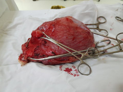 Khối u xơ tử cung nặng gần bằng một em bé sơ sinh hành hạ người phụ nữ khốn khổ