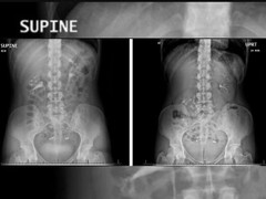 Người phụ nữ khổ sở vì quả thận ‘nổi’ rơi xuống xương chậu mỗi khi đứng lên