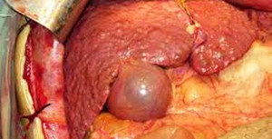 Dẫn xuất của vitamin A có thể giết chết tế bào gốc gây ung thư gan