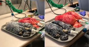 Xem cận cảnh lá phổi đen sì, khò khè, còn ai dám hút thuốc lá