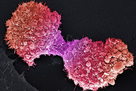 Nếu thấy những dấu hiệu này, 90% bạn bị ung thư tuyến tụy