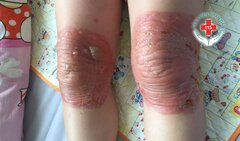 Mặt sưng tấy, chân teo đi, người đàn ông biến dạng vì chữa khớp bằng thuốc đông y trôi nổi