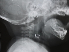 Chiếc lò xo han gỉ mắc trong thực quản bé gái 7 tháng tuổi