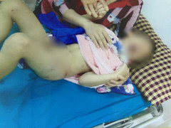 Chơi đuổi bắt trong sân, bé trai bị chó nhà hàng xóm cắn thương tâm