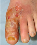 Đắp tỏi tươi trị nấm móng trong suốt 1 tháng trời, người phụ nữ gặp tai họa khủng khiếp