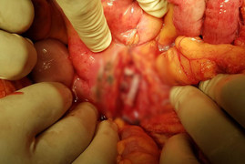 Bị tảng đá rơi vào lưng, chàng trai dập vỡ nhiều cơ quan nội tạng