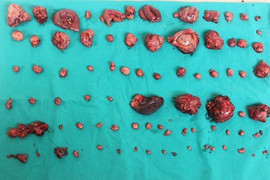 Xem bóc hàng trăm khối u ung thư từ ổ bụng người đàn ông 51 tuổi